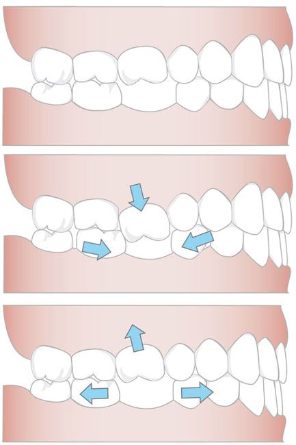 Zahnverschiebung