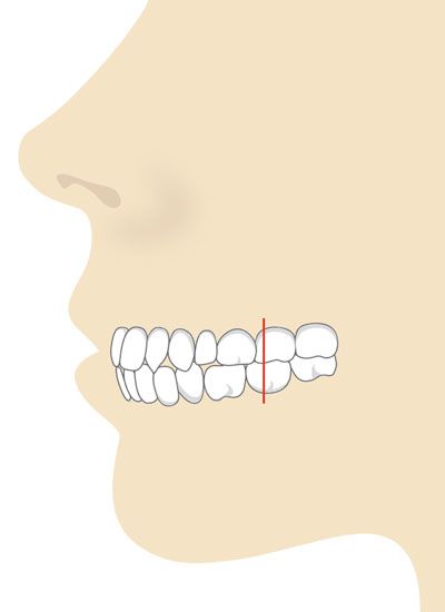 Zähne vorstehende knirschend