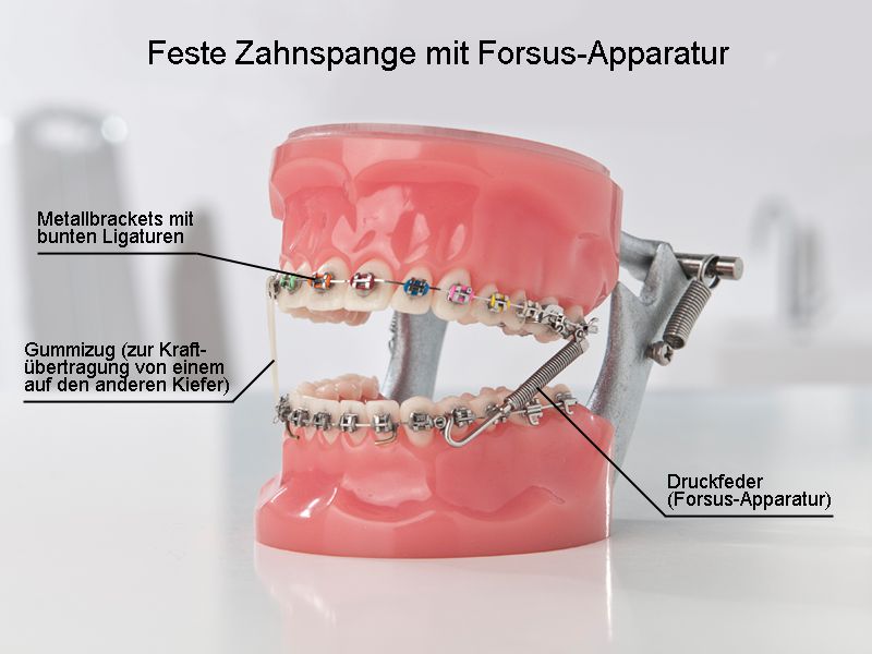 Feste Zahnspange mit Forsus-Apparatur