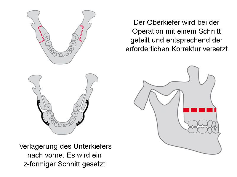 Grafische Darstellung einer Kieferkorrektur