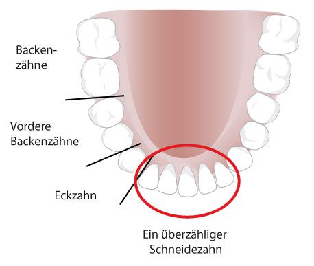 Darstellung Kiefers mit einem überzähligen Schneidezahn