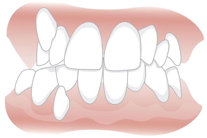 Bleibende zähne nachwachsen können Gebissentwicklung, Zahndurchbruch,