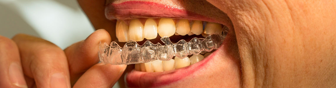 Aligner